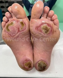 Etapă intermediară — controlul infecției și debridare