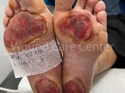 Arsură plantară bilaterală pe neuropatie diabetică