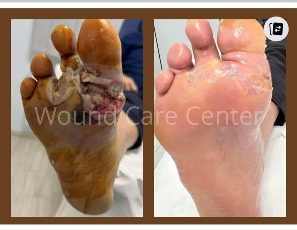 Ulcer neuropatic plantar