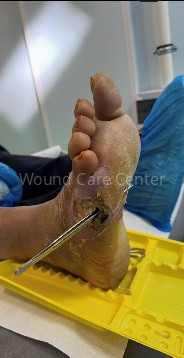Ulcer neuroischemic