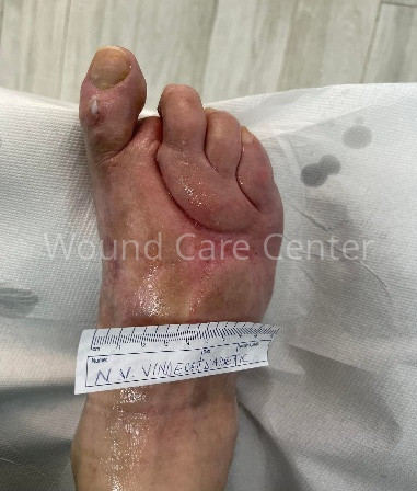 Imagine clinică — etapă a tratamentului