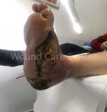 Necroză plantară inițială pe teren ischemic