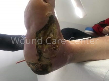 Picior diabetic ischemic complicat