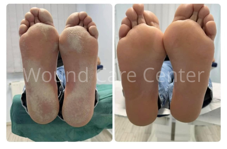 Tinea pedis cronică bilaterală