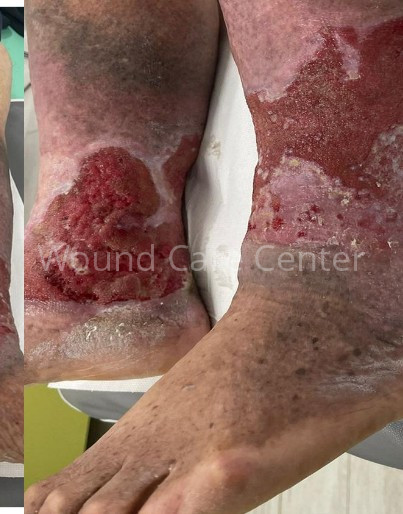 Evoluție intermediară — wound bed preparation