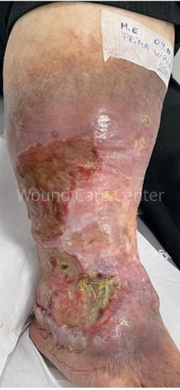 Prezentare inițială — ulcer venos cronic stâng