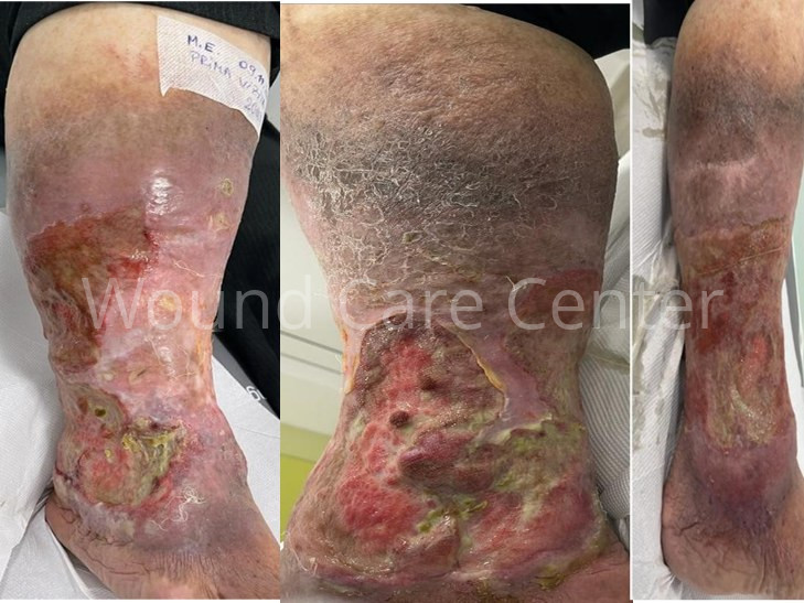 Ulcer venos cronic cu evoluție de peste 20 de ani