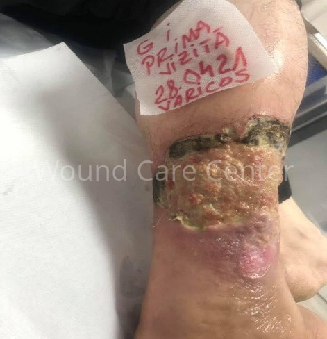 Ulcer venos de gambă