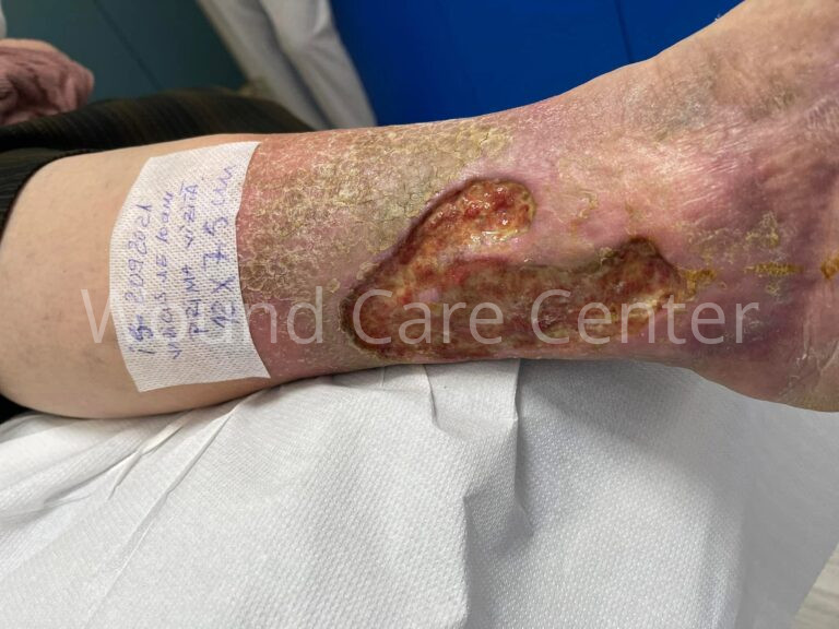 Ulcer venos cronic de gambă la prima vizită